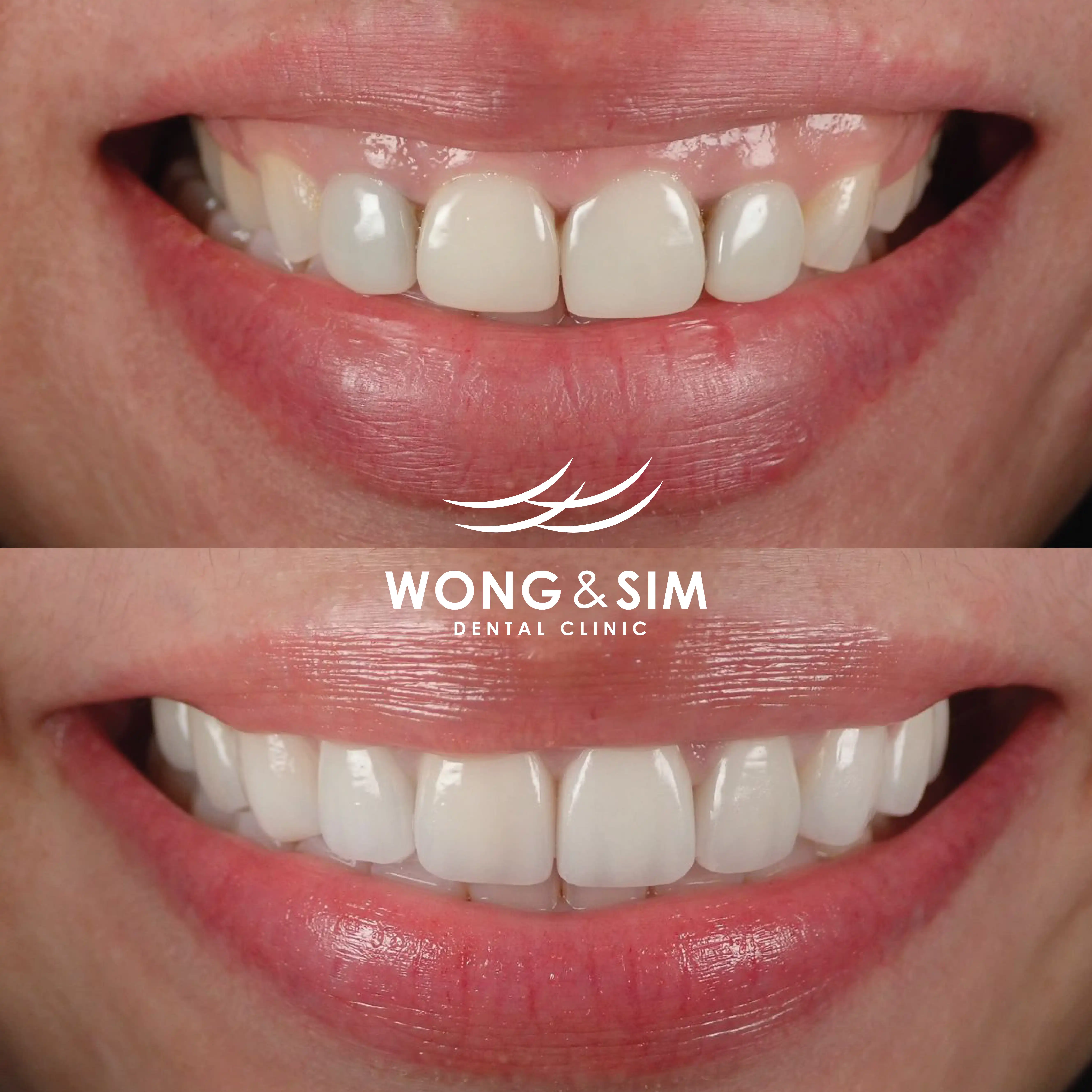 Patient 7 - Dental Implants Before and After